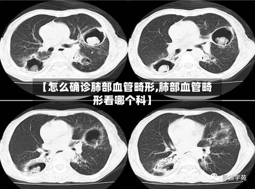 【怎么确诊肺部血管畸形,肺部血管畸形看哪个科】