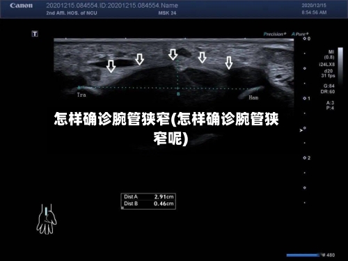 怎样确诊腕管狭窄(怎样确诊腕管狭窄呢)
