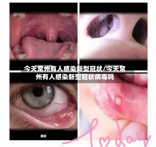 今天常州有人感染新型冠状/今天常州有人感染新型冠状病毒吗