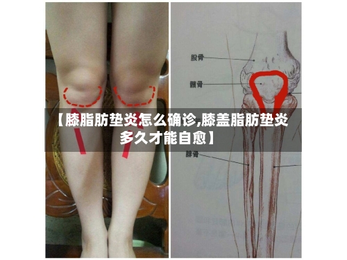 【膝脂肪垫炎怎么确诊,膝盖脂肪垫炎多久才能自愈】