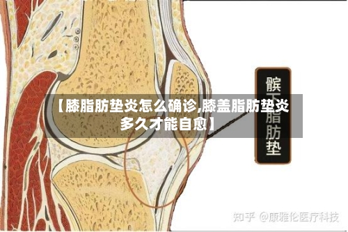【膝脂肪垫炎怎么确诊,膝盖脂肪垫炎多久才能自愈】