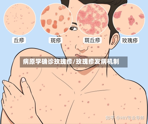 病原学确诊玫瑰疹/玫瑰疹发病机制