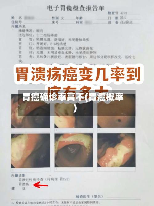 胃癌确诊率高不(胃癌概率)