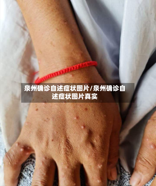 泉州确诊自述症状图片/泉州确诊自述症状图片真实