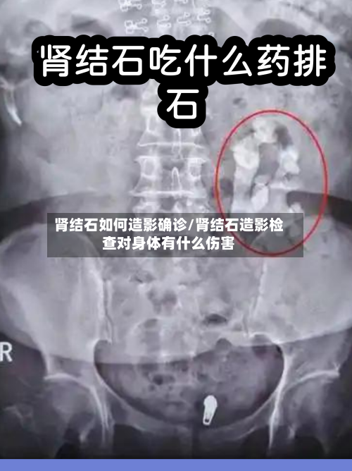 肾结石如何造影确诊/肾结石造影检查对身体有什么伤害