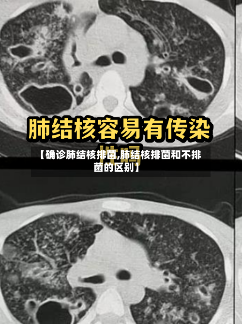 【确诊肺结核排菌,肺结核排菌和不排菌的区别】