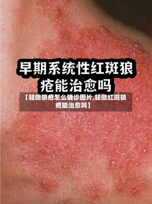 【轻微狼疮怎么确诊图片,轻微红斑狼疮能治愈吗】