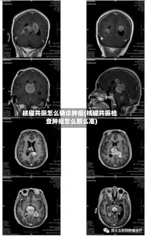 核磁共振怎么确诊肿瘤(核磁共振检查肿瘤怎么那么准)
