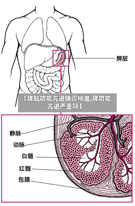 【脾脏功能亢进确诊标准,脾功能亢进严重吗】