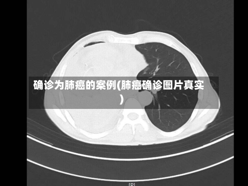 确诊为肺癌的案例(肺癌确诊图片真实)