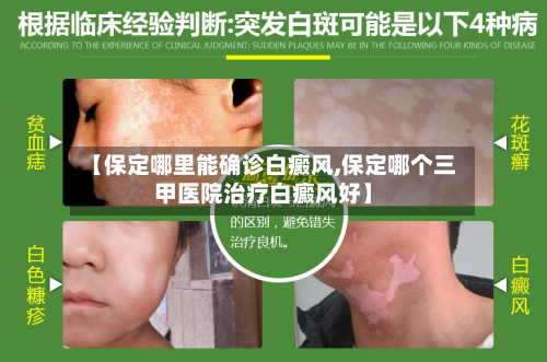 【保定哪里能确诊白癜风,保定哪个三甲医院治疗白癜风好】