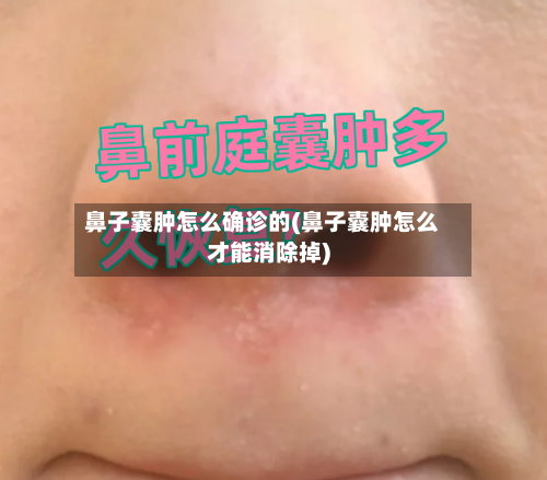 鼻子囊肿怎么确诊的(鼻子囊肿怎么才能消除掉)