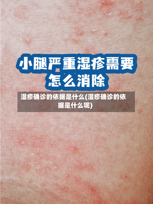 湿疹确诊的依据是什么(湿疹确诊的依据是什么呢)
