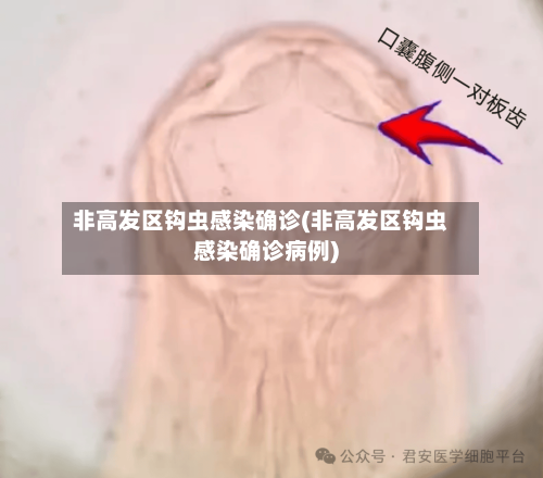 非高发区钩虫感染确诊(非高发区钩虫感染确诊病例)